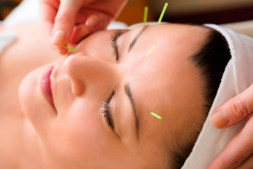 Acuflex Holistics - Facial Acupuncture