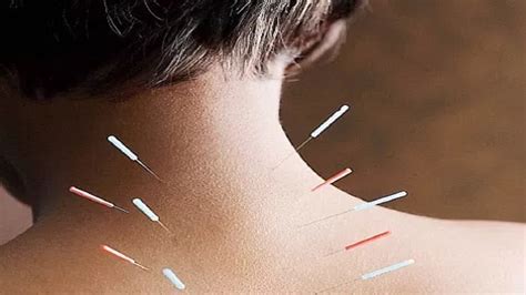 Acuflex Holistics - Acupuncture for Pain